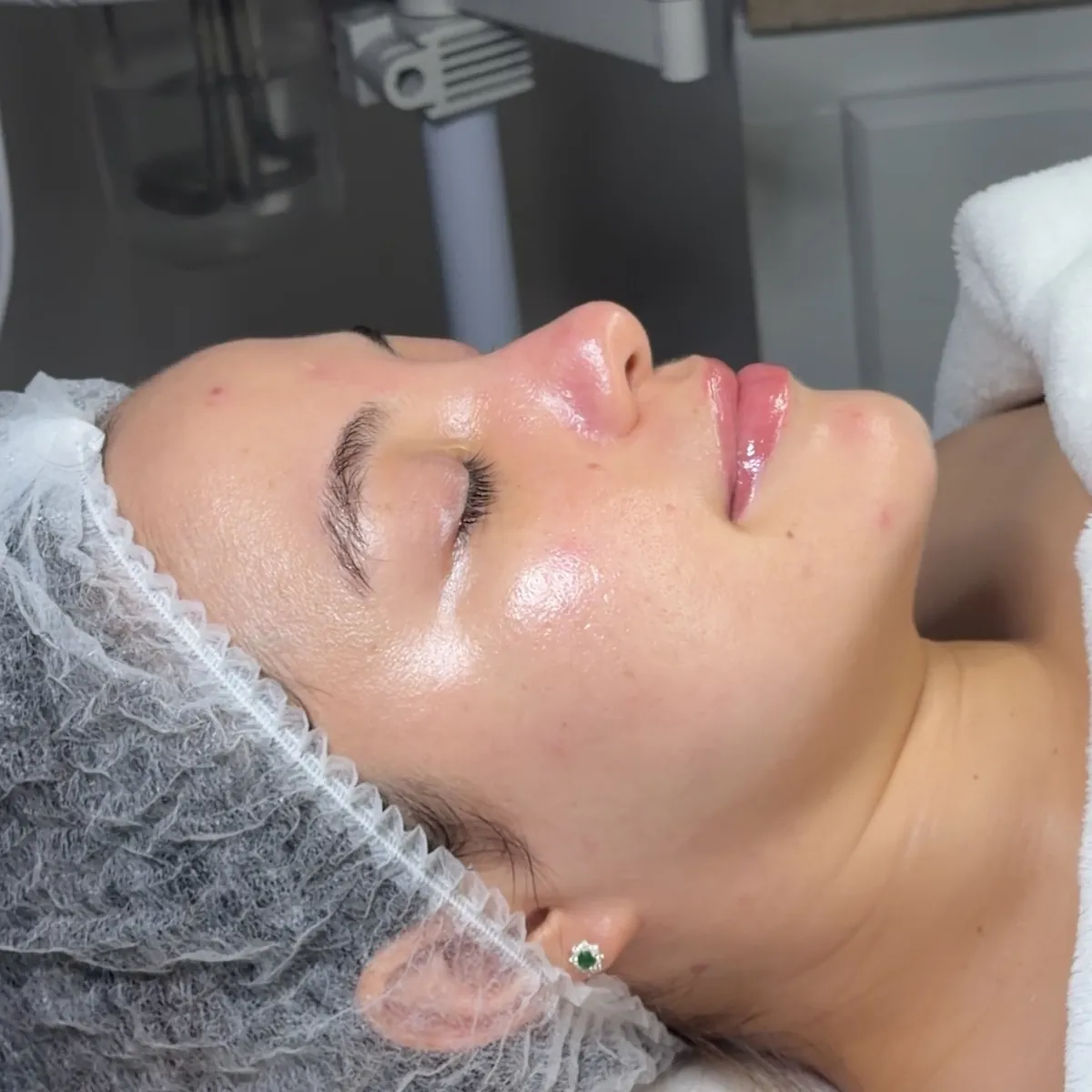 Rostro de paciente tras la limpieza facial profunda en Esbelta, Juliaca